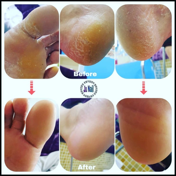 발각질관리/분당용인수원수지보정동백죽전동/주네일 발각질관리/분당용인수원수지보정동백죽전동/주네일