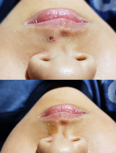 남자 중학생 얼굴점,팔점 co2점빼기 : 네이버 블로그 남자 중학생 얼굴점,팔점 Co2점빼기 : 네이버 블로그