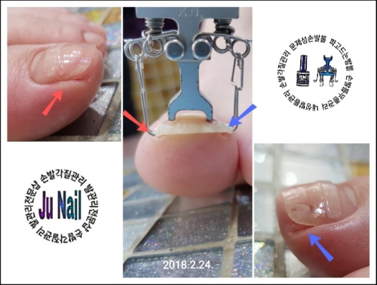 내성발톱/분당용인수원수지보정동백죽전동/주네일/파고드는발톱 내성발톱/분당용인수원수지보정동백죽전동/주네일/파고드는발톱