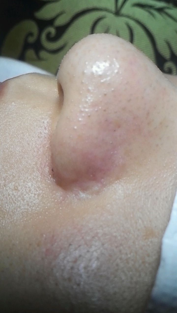  지긋지긋한 피부속 노폐물 없애는 피부관리
