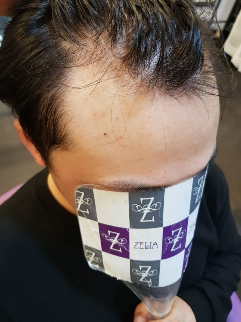 앞머리탈모 고민도 대구증모술 전문 젤리아헤어 남성연장 2