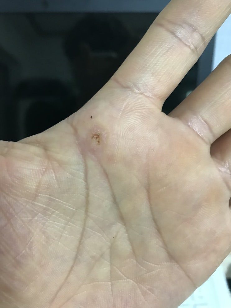 [고은미래피부과 전주점] 사마귀 수술 2차 후 피부 재생완료~~손금 볼 줄 아시는분?