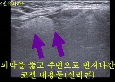 가슴보형물파손되어 실리콘이 피막을 찢고 주변까지 번진 분: 보형물제거/교체수술