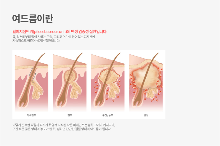 [선정릉역피부과 삼성동여드름] 시크릿레이저 - ST성모피부과