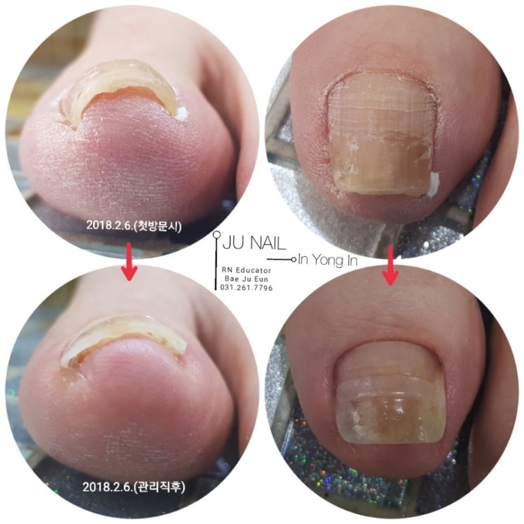 솜말아끼운발톱/분당용인수원수지보정동백죽전동/주네일/파고드는발톱 솜말아끼운발톱/분당용인수원수지보정동백죽전동/주네일/파고드는발톱