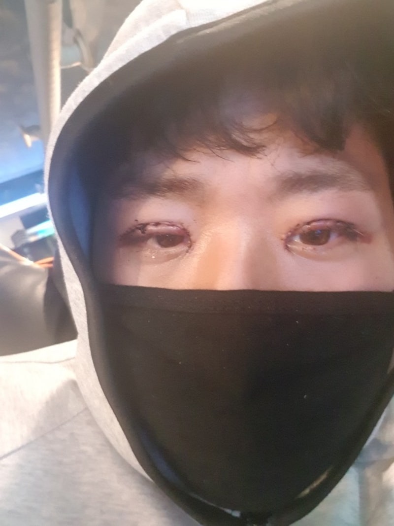 대전 신안과 안검하수(쌍수)수술 후기