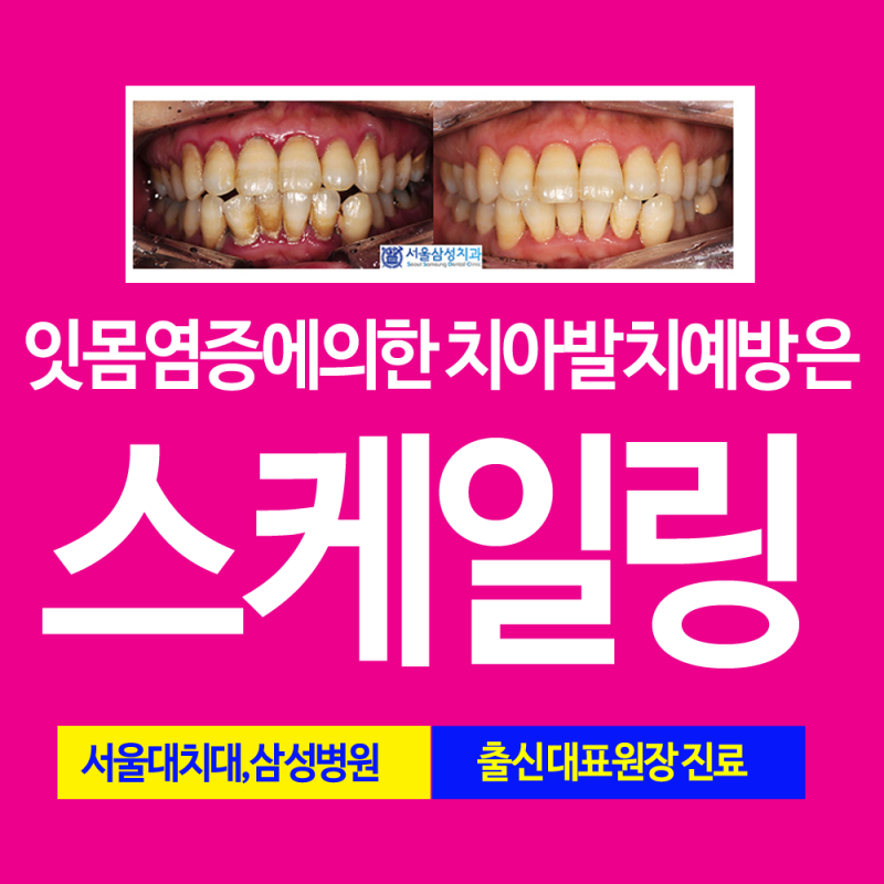 동대문 스케일링 잇몸치료 체계적인절차로