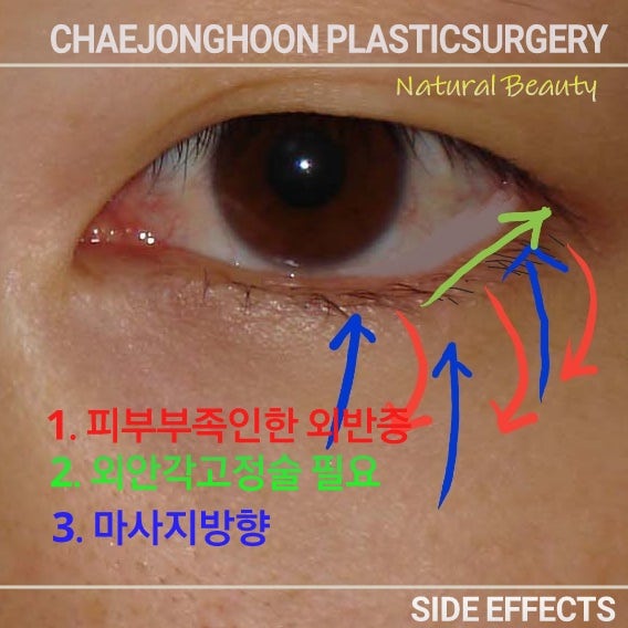 광주의 하안검이 처진 눈빛을 바꾸자!