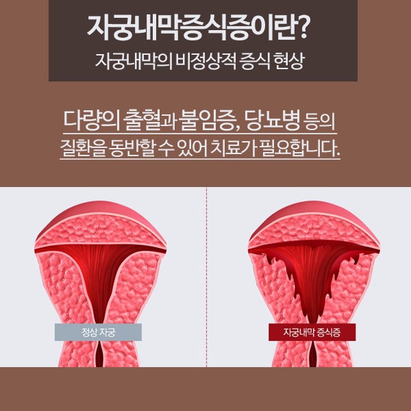 자궁내막증식증 증상이 발생한 경우 신속하게 조치해 주시기 바랍니다. 10