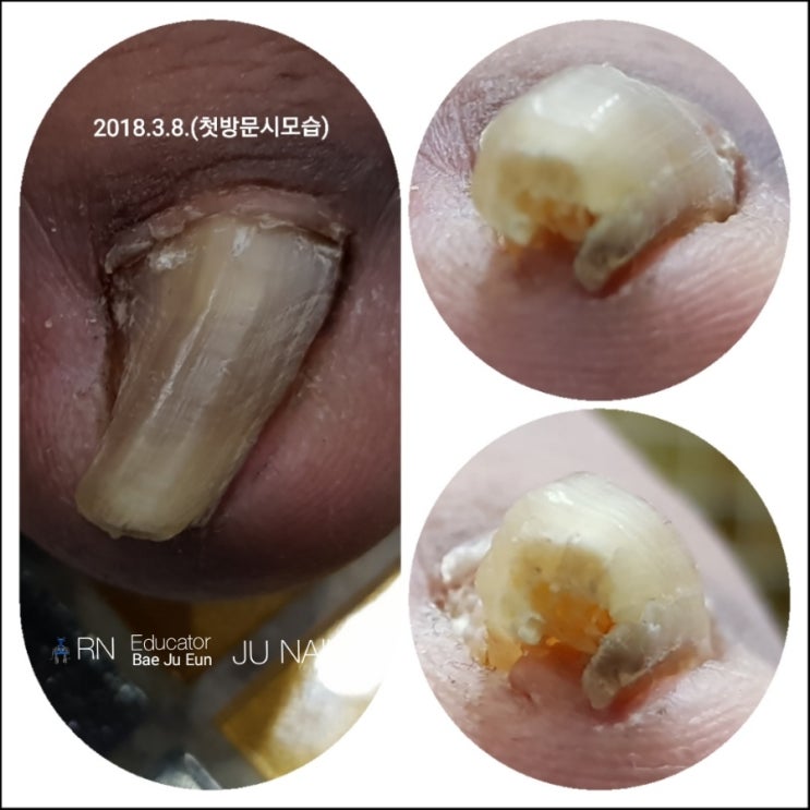 세상에이런발톱/분당용인수원수지보정동백죽전동/주네일/파고드는발톱