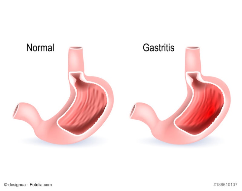속쓰림의 연속, 혹시 위염 ? 8