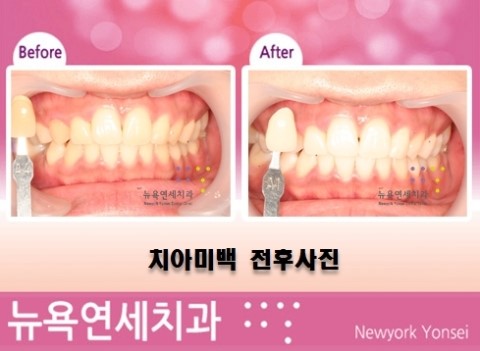  치아미백을 빠르게 하고 싶다면 원데이 치아미백으로!!