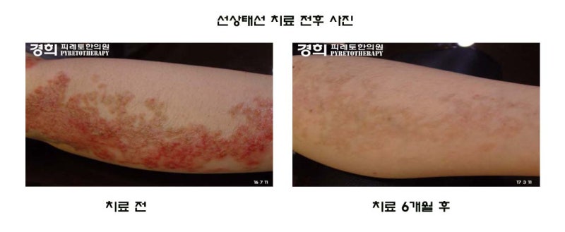태선이란?  (태선화 / 태선 치료 수기)