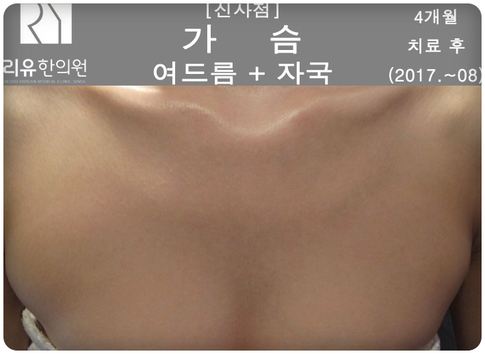  리유한의원은 가슴여드름원인부터 치료합니다