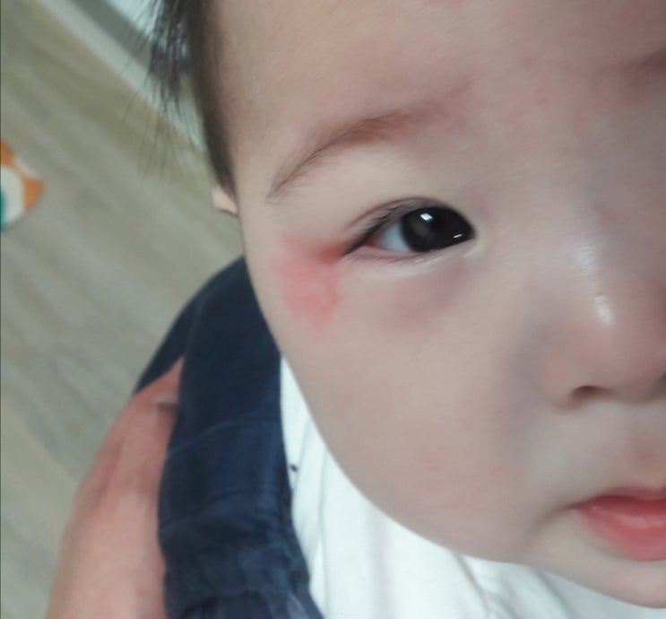 아기 두드러기 아이 얼굴 눈에 생겨서 2
