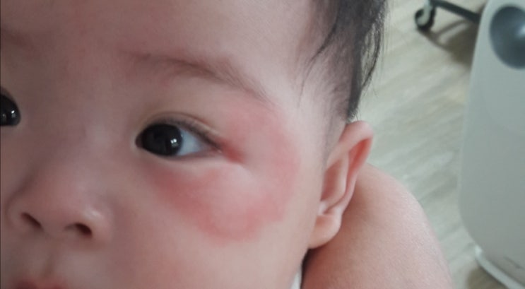 아기 두드러기 아이 얼굴 눈에 생겨서 3