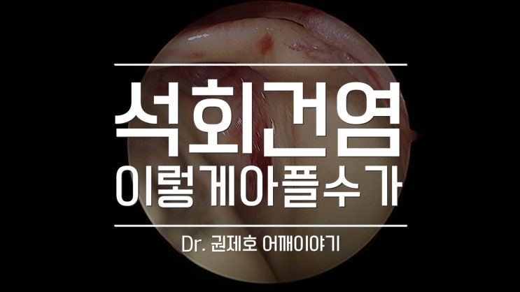  석회건염 통증은 왜 오는가?