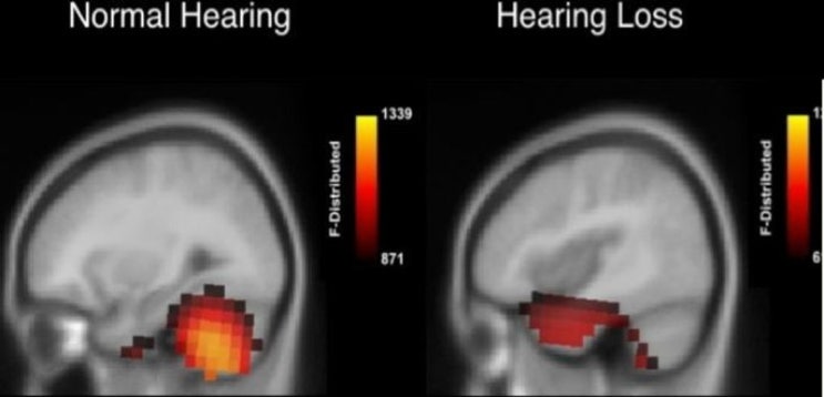 뇌의 신경가소성 그리고 청력