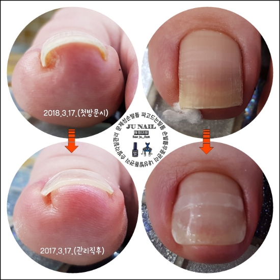솜끼운발톱/분당용인수원수지보정동백죽전동/주네일/내향성발톱 솜끼운발톱/분당용인수원수지보정동백죽전동/주네일/내향성발톱