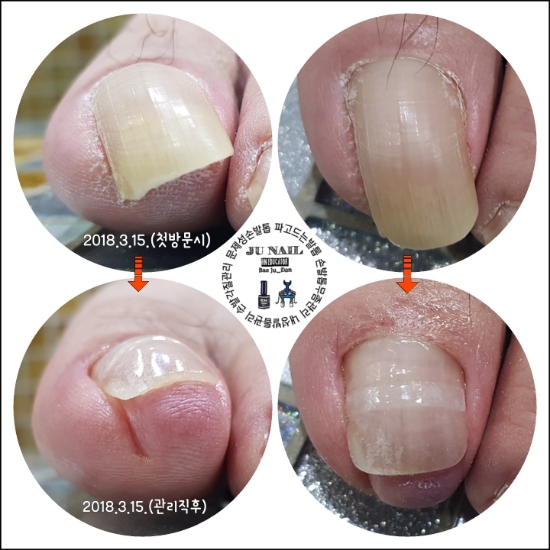 심한내향성발톱/분당용인수원수지보정동백죽전동/주네일/파고드는발톱 심한내향성발톱/분당용인수원수지보정동백죽전동/주네일/파고드는발톱