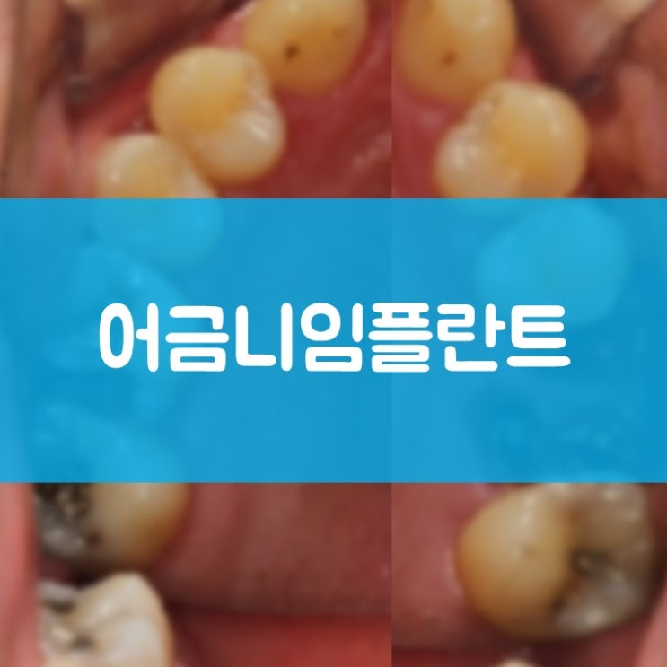 수원임플란트 매탄동치과 어금니임플란트 중간에 어금니가 없는데 이대로 둬도 될까요?