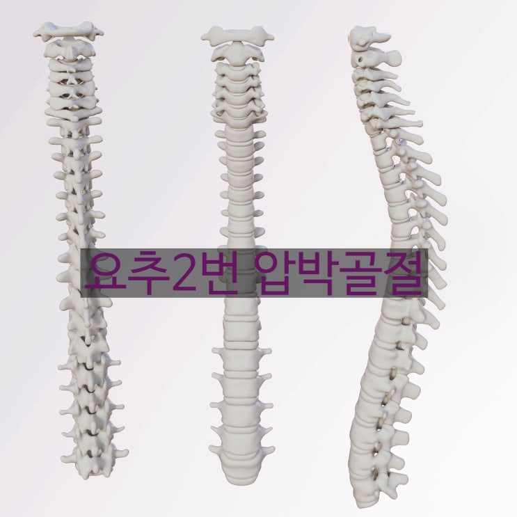  요추2번압박골절(L2) 장해판정과 보험금!