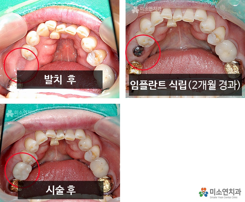 충치부터 임플란트까지 평택치과 보철치료