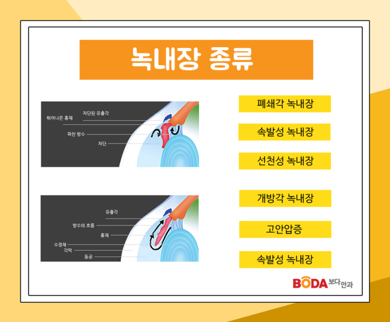 [대전안과] 녹내장 원인과 치료