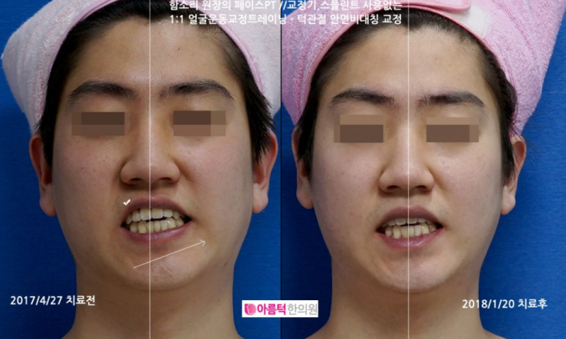 무턱변형 안면비대칭, 앞니변경등 치료케이스 : 네이버 블로그