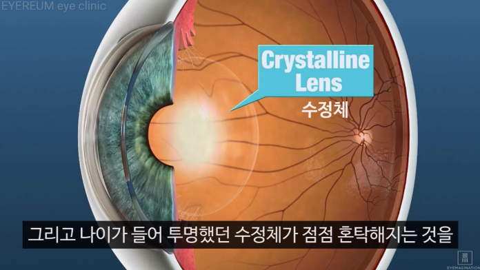 백내장수술가격 보다 더 중요한 것은?