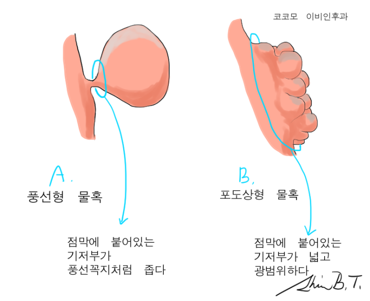  비용종 코물혹, 코폴립의 종류와 수술적 치료의 핵심 원칙