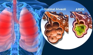 급성호흡곤란증후군 (Acute respiratory distress syndrome, ARDS)