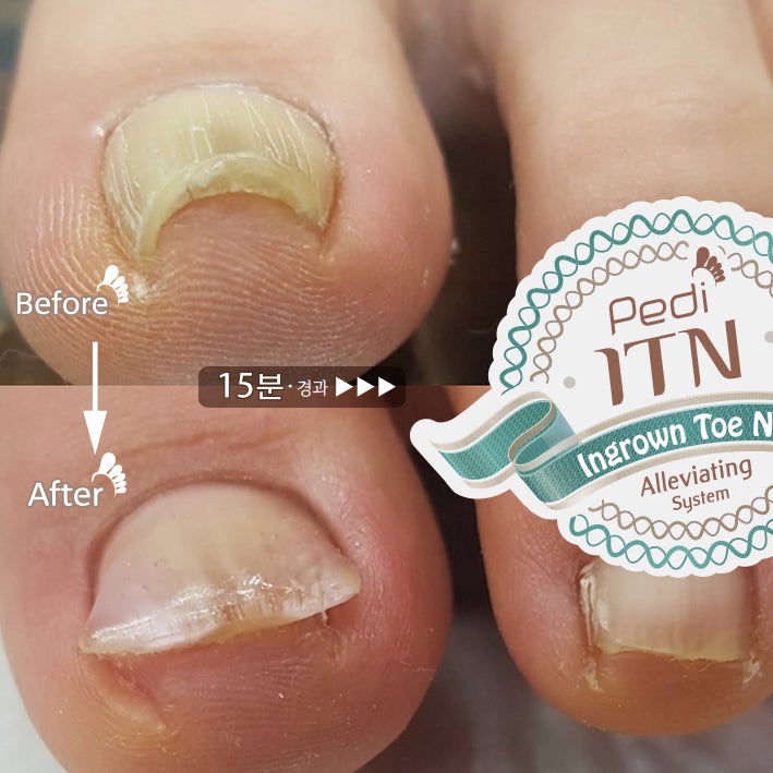 부산피부과 전문의 피부 파고드는 내성손톱 4