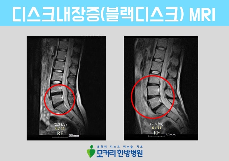 퇴행성 디스크를 위한 3가지 케이브 스파에 대해 자세히 알아보십시오.