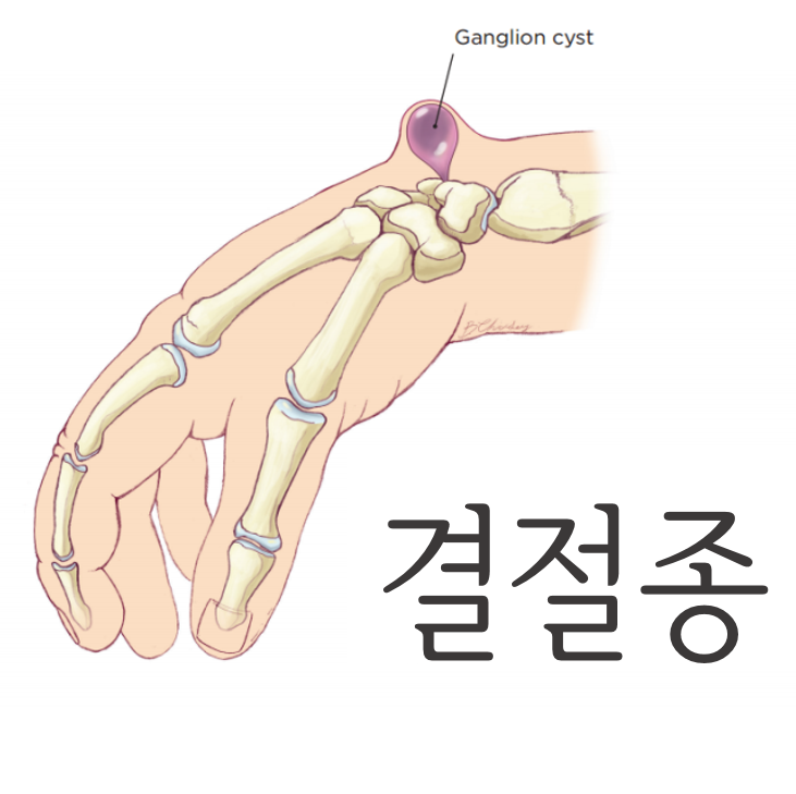 하남결절종의 원인과 치료 보개한의원 발등에 생긴 결절종을 없앤다.