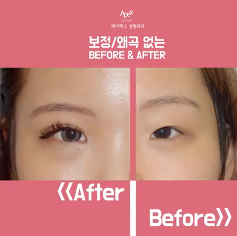 눈성형 잘하는 성형외과 추천.