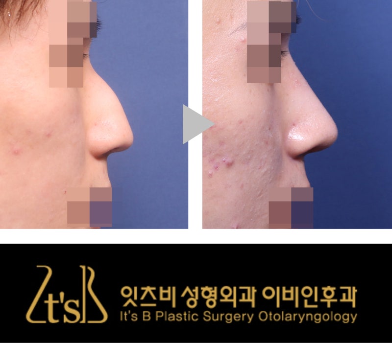 남자 매부리코 교정 시 코필러? 무보형물코성형? : 네이버 블로그 남자 매부리코 교정 시 코필러? 무보형물코성형? : 네이버 블로그