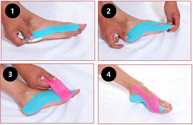 무지외반 깔창 운동화 테이핑보다 도움이 되는 방법