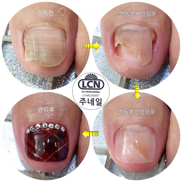 발톱때문에한번도해보지못한패디큐어/분당용인수원수지보정동백죽전동/주네일/무좀발톱