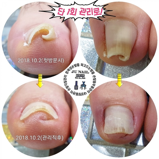 골뱅이처럼말린파고든발톱1회관리후/분당용인수원수지보정동백죽전동/주네일/내향성발톱 골뱅이처럼말린파고든발톱1회관리후/분당용인수원수지보정동백죽전동/주네일/내향성발톱