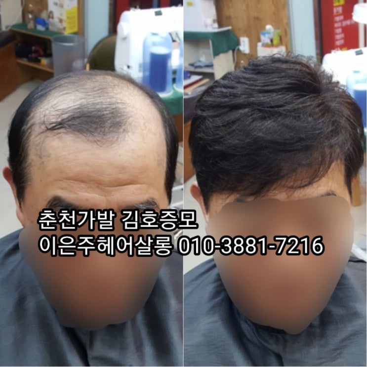  춘천가발 김호증모 남자맞춤가발전문점 이은주헤어살롱 오늘도 맞춤가발 피팅 합니다~^^