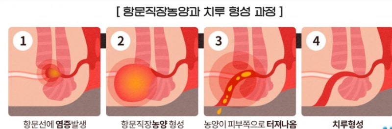 건강」 항문 농양 제거 수술 후 4주차 리얼 후기 (feat. 살이 무서울 정도로 차오른 엘리트 환자 주니파파) : 네이버 블로그 건강」 항문 농양 제거 수술 후 4주차 리얼 후기 (Feat. 살이 무서울 정도로 차오른 엘리트 환자 주니파파) : 네이버 블로그