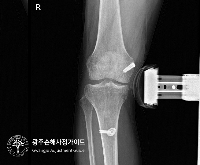 [광주 손해사정] 무릎골절 후유장해 보험금 어떻게 보상받을까? :: 광주손해사정가이드 장한서