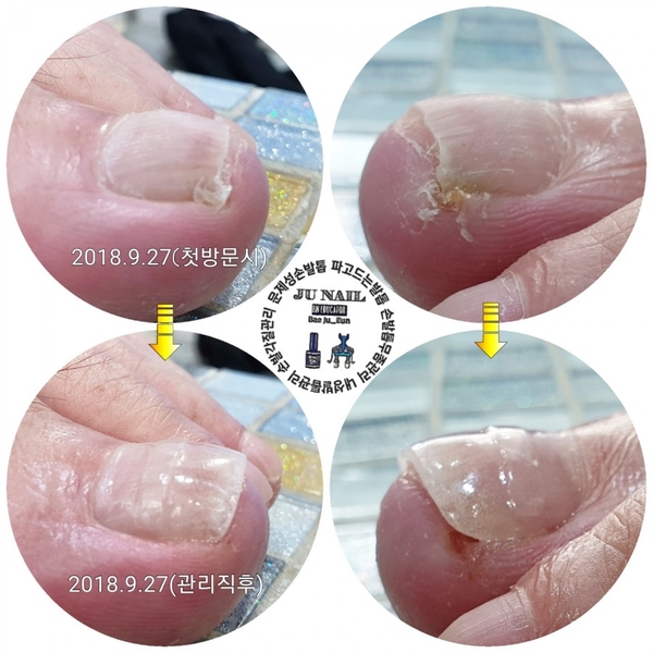 살속깊이파고든염증발톱1회관리후/분당용인수원수지보정동백죽전동/주네일/파고드는내향성발톱 살속깊이파고든염증발톱1회관리후/분당용인수원수지보정동백죽전동/주네일/파고드는내향성발톱