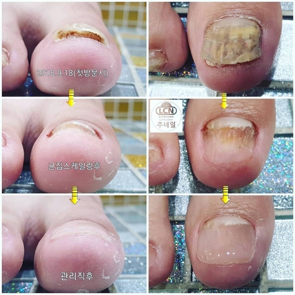 발톱색깔이변했어요/분당용인수원수지보정동백죽전동/주네일/무좀발톱관리전문샵 발톱색깔이변했어요/분당용인수원수지보정동백죽전동/주네일/무좀발톱관리전문샵