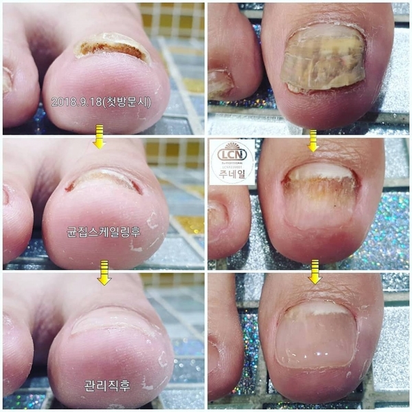 발톱색깔이변했어요/분당용인수원수지보정동백죽전동/주네일/무좀발톱관리전문샵