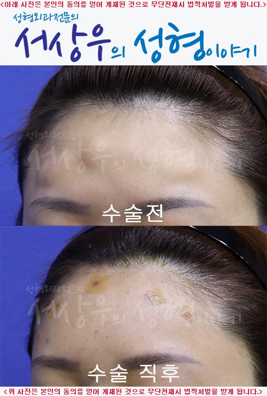 이마 필러의 부작용으로 이마가 고르지 못한 경우? 주입구 용해 주입 절차에 따라 탈거됨