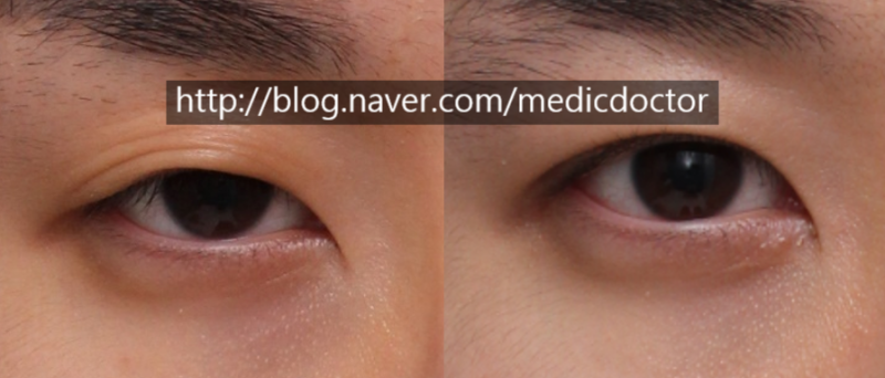 Patient photo after non-incisional ptosis correction