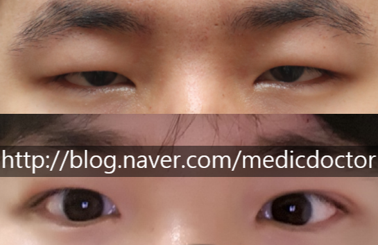 Example of thick eyelids unsuitable for non-incisional method