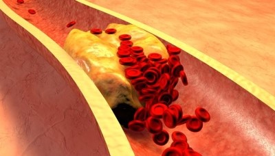  HDL 콜레스테롤과 LDL 콜레스테롤